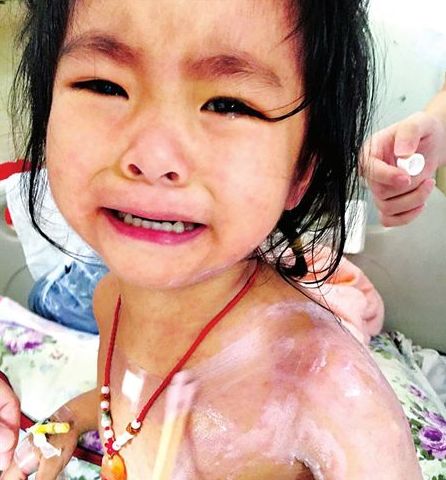 3歲的蘭蘭，全身紅疹，因疼癢難忍而大哭