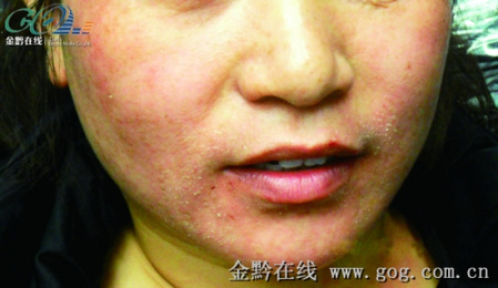 女子涂化妝品致滿(mǎn)臉紅腫留黑斑索賠遭商家威脅