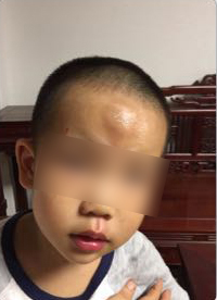 男童被送快遞的電動車撞飛一米多，額頭腫起乒乓球大的包